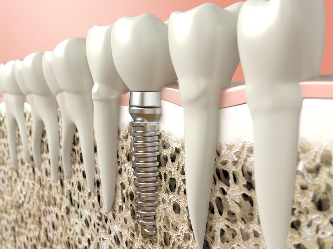 Dental Implants  Deming, NM 